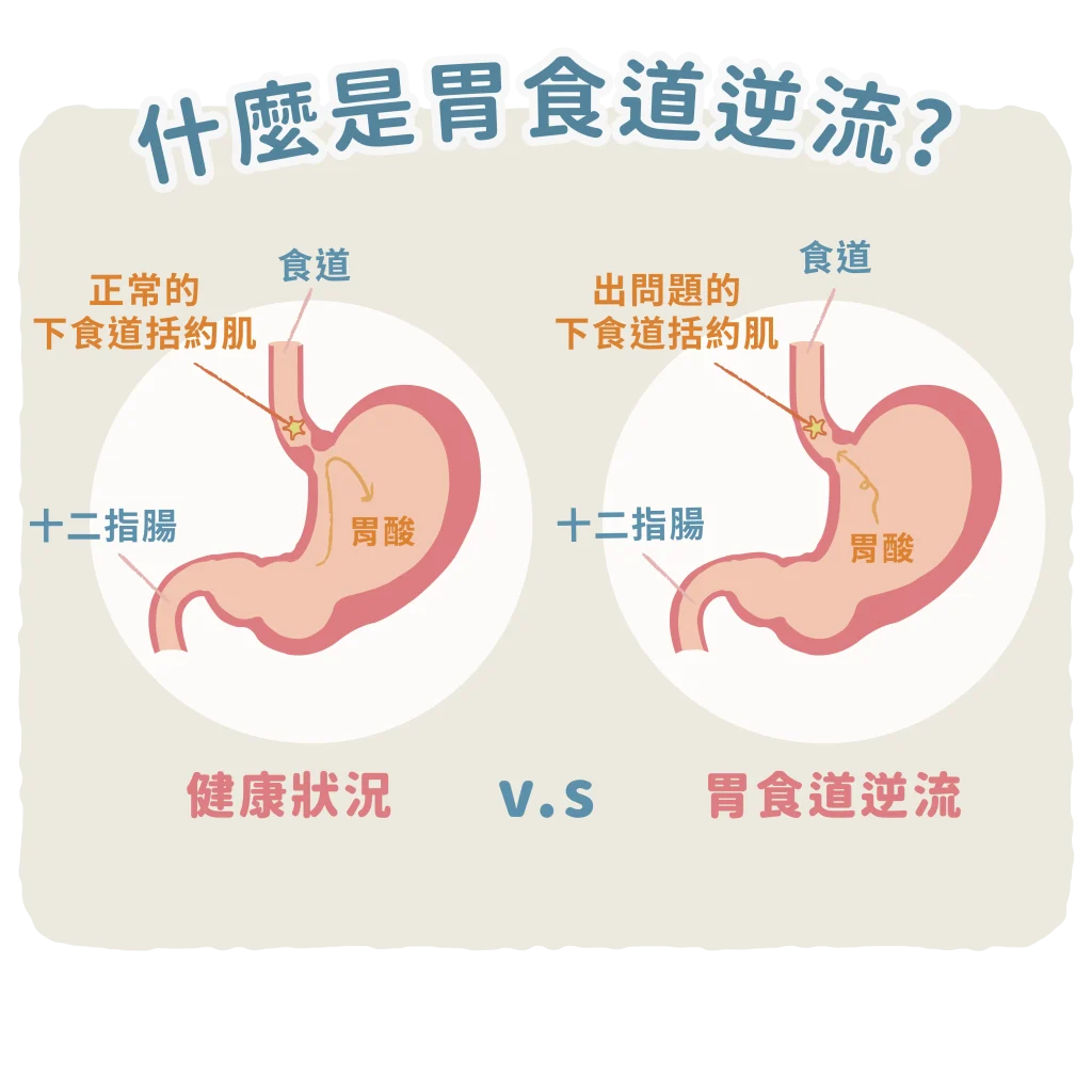 【什麼是胃食道逆流】